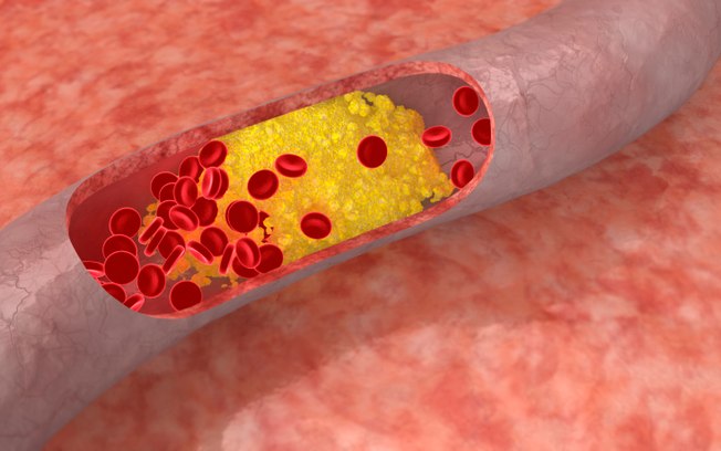 O abacate é rico em beta-sitosterol, um composto que tem comprovadamente baixado os níveis de colesterol. Comer abacate durante uma semana pode baixar o colesterol mal em até 17 por cento