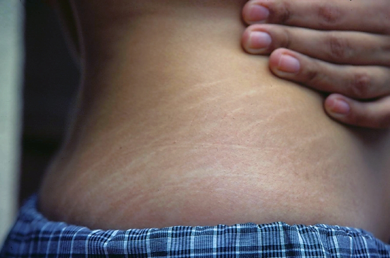 As estrias costumam aparecer no quadril, no bumbum e nos seios. Os braços e as coxas também são locais onde elas podem aparecer.