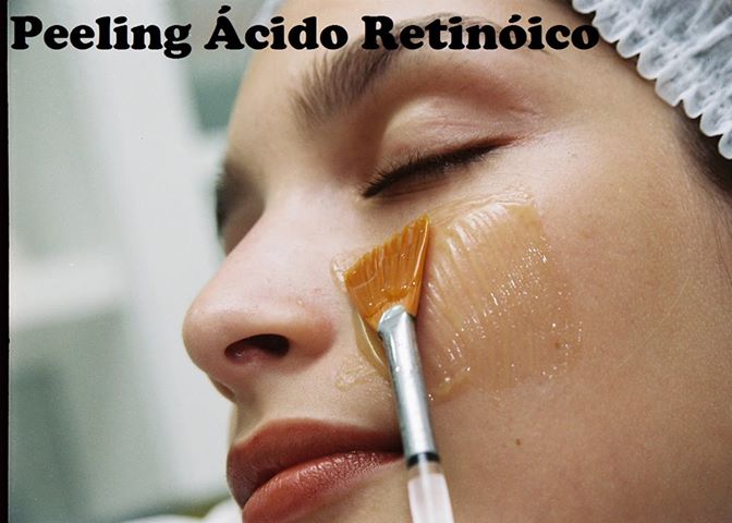 Não é o método mais eficaz mas é um aliado poderoso já que promove a hidratação da pele produzindo novo colágeno. O tratamento com creme é demorado.