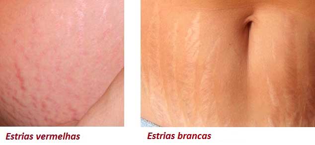 As estrias vermelhas são recentes. São fissuras que acabaram de se formar e, portanto, ainda estão inflamadas. O tratamento nessa fase consegue excelentes resultados. As estrias brancas são cicatrizes já formadas, mais difíceis de serem tratadas, mas existem muitos tipos de tratamento médico.