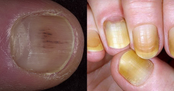 8 coisas que as nossas unhas podem dizer sobre a nossa saúde